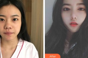 撫州韓尚醫(yī)療美容門診部戴凌欽整形價(jià)格表附切開雙眼皮案例展示