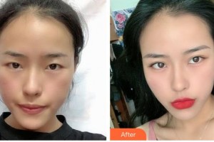 撫州江醫(yī)生醫(yī)療美容門診部周璇整形價(jià)格表附切開雙眼皮案例展示