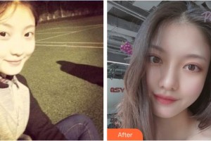 上饒尚美醫(yī)療美容門診部周敏整形價(jià)格表附開內(nèi)眼角案例展示