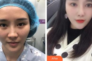 上饒平安醫(yī)院醫(yī)療美容科劉家榮整形價(jià)格表附下瞼整形案例展示