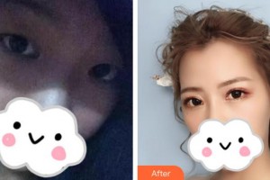 上饒平安醫(yī)院醫(yī)療美容科董芳整形價(jià)格表附眼部綜合案例展示