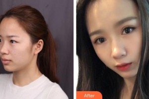 上饒市人民醫(yī)院燒傷整形外科徐湯靈整形價(jià)格表附眼部綜合案例展示