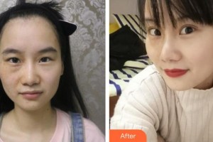 上饒市人民醫(yī)院燒傷整形外科周方政整形價(jià)格表附眼部綜合案例展示