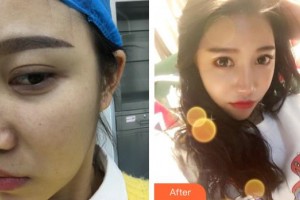 上饒尚美醫(yī)療美容門診部王功槐整形價(jià)格表附埋線提升案例展示