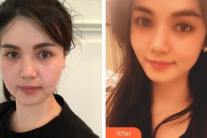 上饒尚美醫(yī)療美容門診部江嵐整形價格表附埋線提升案例展示