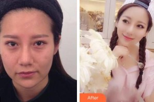 上饒尚美醫(yī)療美容門診部余婷整形價(jià)格表附埋線提升案例展示