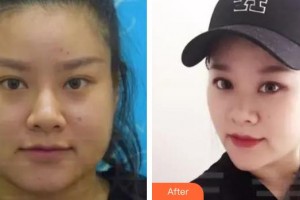 上饒協(xié)和醫(yī)院整形美容科孫家政整形價(jià)格表附射頻緊膚案例展示