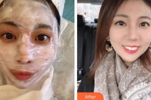 上饒愛爾眼科醫(yī)院鮑暉整形價格表附激光美膚激光案例展示