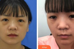 上饒愛爾眼科醫(yī)院陳勝整形價格表附激光去眼袋案例展示