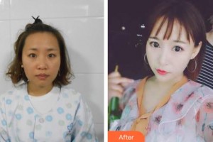 上饒愛爾眼科醫(yī)院徐雅萍整形價格表附眼部綜合案例展示