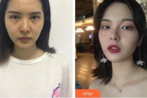 平頂山藝美醫(yī)療美容醫(yī)院白勝萬整形價(jià)格表附鼻部綜合案例展示