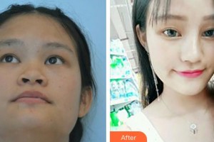 平頂山星美醫(yī)療美容門診部張海明整形價格表附鼻部綜合案例展示