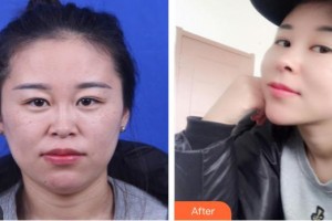 平頂山錦華醫(yī)療美容診所趙力軍整形價格表附鼻部綜合案例展示