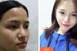 平頂山藝美醫(yī)療美容醫(yī)院任擁軍整形價格表附鼻部綜合案例展示