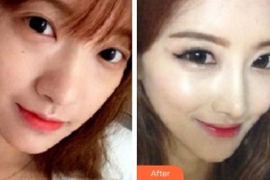 平頂山藝美醫(yī)療美容醫(yī)院潘圣戰(zhàn)整形價(jià)格表附鼻部綜合案例展示