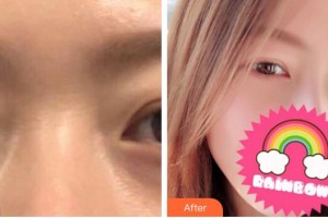 新疆威茲曼整形外科醫(yī)院馬艷麗整形價(jià)格表附內(nèi)切祛眼袋案例展示