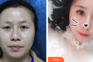 烏魯木齊市友誼醫(yī)院整形科宋路整形價(jià)格表附切開雙眼皮案例展示