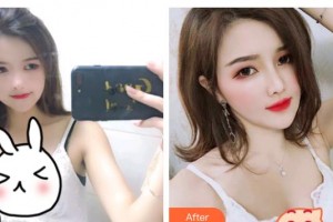 烏魯木齊王姣醫(yī)療美容診所王蛟整形價(jià)格表附耳軟骨復(fù)合隆鼻案例展示