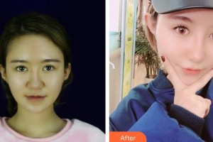 烏魯木齊黎美整形門診部張春亮整形價(jià)格表附隆鼻案例展示