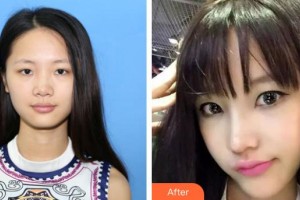 烏魯木齊伊麗莎白整形美容醫(yī)院李哲權(quán)整形價(jià)格表附假體隆鼻案例展示