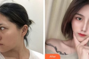 烏魯木齊王共禮醫(yī)療美容整形門診部王共禮整形價(jià)格表附鼻部綜合案例展示