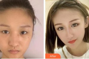 烏魯木齊普瑞眼科醫(yī)院胡裕坤整形價(jià)格表附眼部綜合案例展示