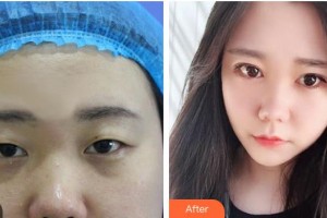 烏魯木齊伊麗莎白整形美容醫(yī)院楊春梅整形價(jià)格表附定點(diǎn)雙眼皮案例展示