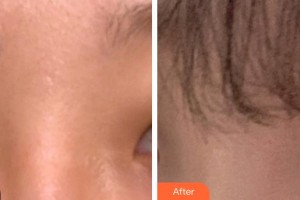 烏魯木齊藥業(yè)集團(tuán)附屬醫(yī)院毛發(fā)種植科肖振鋒整形價(jià)格表附眼部綜合案例展示