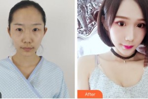 烏魯木齊慈善醫(yī)院整形美容科文碧云整形價格表附切開雙眼皮案例展示