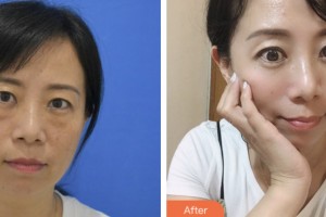 昆山百達麗醫(yī)療美容門診部沈軍整形價格表附激光去眼袋案例展示