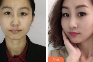 昆山百達麗醫(yī)療美容門診部薛麗華整形價格表附去痘印痘坑案例展示