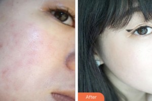 昆山百達麗醫(yī)療美容門診部馬志丹整形價格表附去痘印痘坑案例展示