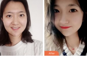 昆山百達麗醫(yī)療美容門診部楊宇光整形價格表附光子嫩膚案例展示