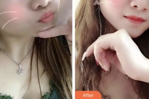 昆山第一人民醫(yī)院燒傷整形科肖貴喜整形價格表附紅藍光祛痘案例展示