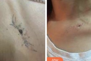 昆山鉑特麗醫(yī)療美容門診部趙新星整形價格表附激光去紋身案例展示