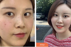 昆山鉑特麗醫(yī)療美容門診部金起憲整形價格表附激光祛斑案例展示