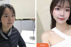 昆山鉑特麗醫(yī)療美容門診部李云鳳整形價格表附紅藍光祛痘案例展示