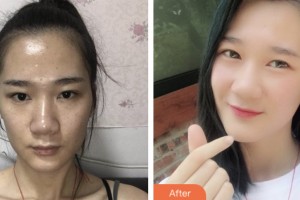 昆山鉑特麗醫(yī)療美容門診部閔熙埈整形價格表附微針水光案例展示