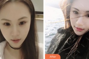 昆山魅萊醫(yī)療美容門診部陳軍芹整形價格表附激光美膚激光案例展示