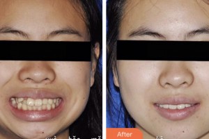 昆山萌牙客口腔門診部王雨生整形價格表附隱形托槽矯正案例展示