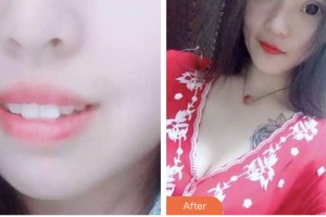 昆山萌牙客口腔門診部沈衛(wèi)整形價格表附牙齒隱形矯正案例展示