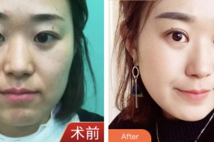 昆山愛爾眼科醫(yī)院肖耀廷整形價格表附眼部綜合案例展示