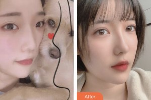 昆山愛爾眼科醫(yī)院朱彤整形價格表附眶隔脂肪釋放案例展示