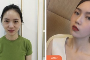 昆山愛爾眼科醫(yī)院孟亞麗整形價格表附切開雙眼皮案例展示