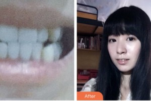 昆山同濟(jì)口腔醫(yī)院胡宏娥整形價格表附金屬托槽矯正案例展示
