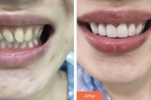 昆山同濟(jì)口腔醫(yī)院劉努整形價格表附牙貼面案例展示