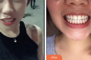 昆山同濟(jì)口腔醫(yī)院田連松整形價格表附超聲波潔牙案例展示