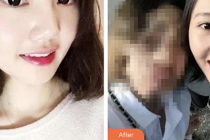 昆山禾豐口腔醫(yī)院張明進(jìn)整形價格表附牙齒隱形矯正案例展示