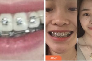 昆山同濟(jì)口腔醫(yī)院顧圣祖整形價格表附金屬托槽矯正案例展示