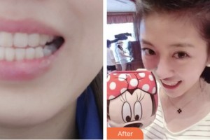 昆山禾豐口腔醫(yī)院朱庭儀整形價格表附隱形托槽矯正案例展示